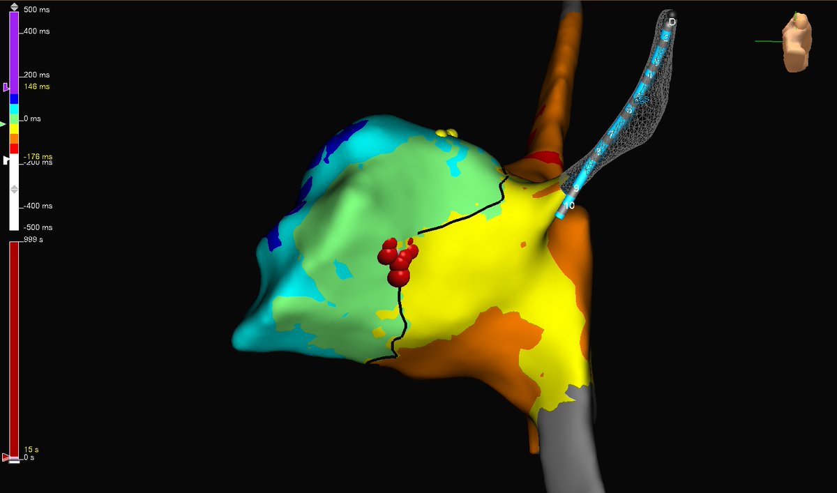 subparsonsmaps's tweet image. Utilized #HDGrid to quickly make an open window map of this AP in a WPW patient. Preexcitation was lost on the first burn after 2 seconds of RF. #mapmoreburnless #EPeeps @AbbottCardio