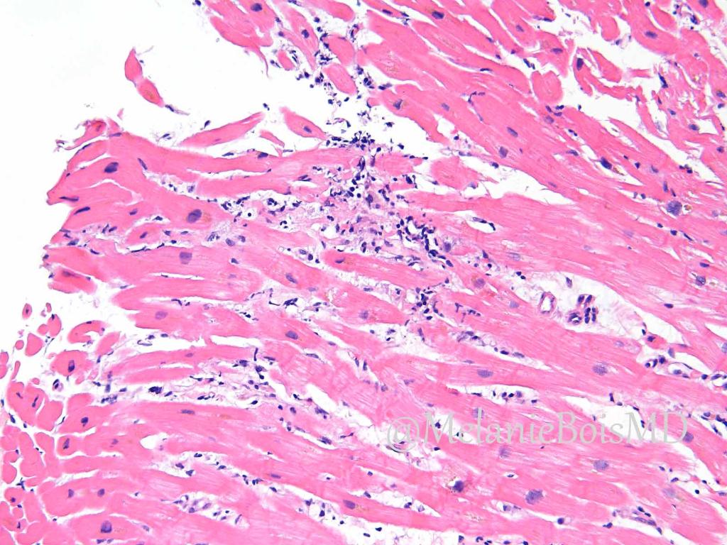 Mayo Clinic Pathology (@mayoclinicpath) on Twitter photo 1/5
#HEARTThursday w/ <a href="/MelanieBoisMD/">Melanie Bois</a>! Where did that week go!?! But wait! For your patience, we have a two-fer bonus question! Hold on tight, and get ready for a great case comin’ at ya now!
The floor is yours, Dr. Bois! 1/5
#HEARTThursday w/ <a href="/MelanieBoisMD/">Melanie Bois</a>! Where did that week go!?! But wait! For your patience, we have a two-fer bonus question! Hold on tight, and get ready for a great case comin’ at ya now!
The floor is yours, Dr. Bois!