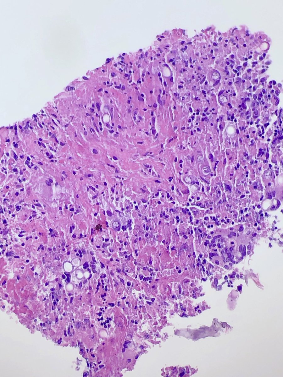 Lacey Schrader (@ljschradermd) on Twitter photo Pulmonary Blastomycosis characterized by broad based-budding and double contoured thick wall highlighted on GMS. <a href="/MayoClinicPath/">Mayo Clinic Pathology</a> <a href="/AndrewLayman/">andrewlayman</a> #dimorphicfungi #Bforbroadbasedbudding Pulmonary Blastomycosis characterized by broad based-budding and double contoured thick wall highlighted on GMS. <a href="/MayoClinicPath/">Mayo Clinic Pathology</a> <a href="/AndrewLayman/">andrewlayman</a> #dimorphicfungi #Bforbroadbasedbudding