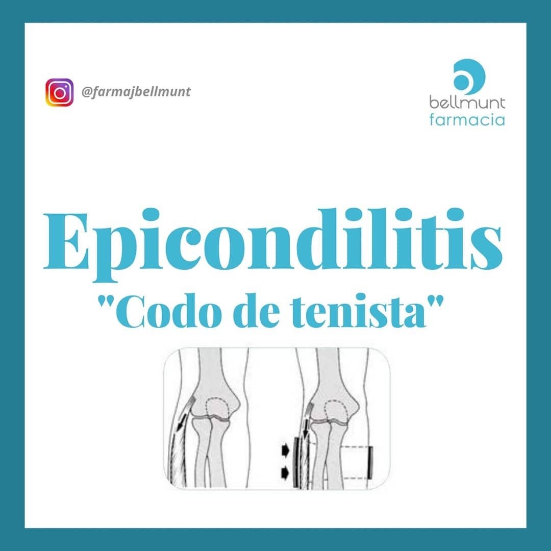FarmaJBellmunt's tweet photo. ¿𝗦𝗮𝗯𝗲𝘀 𝗾𝘂𝗲 𝗲𝘀 𝗹𝗮 #𝗲𝗽𝗶𝗰𝗼𝗻𝗱𝗶𝗹𝗶𝘁𝗶𝘀 𝗼 #C𝗼𝗱𝗼D𝗲𝗹T𝗲𝗻𝗶𝘀𝘁𝗮?
En nuestra infografía te lo explicamos,así como el tratamiento¿Sabias que sólo un 5% de los tenistas sufre este síndrome?
En la población lo padece entre el 1 y 3% con mayor incidencia + en 🚹 https://t.co/IzBlE0v2fX