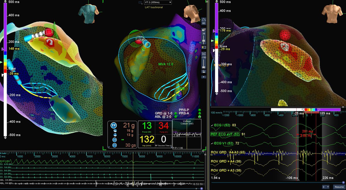 #HDGrid @gopi_gdanda1 35min case, 32000pt HD Grid map, 281ms on AL Papillary Muscle spanning all of diastole, 0.7s of ablation while ramping up to 50W on burn #1 and no more VT.  Great way to start the weekend!