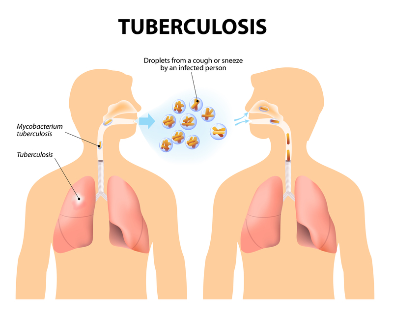 321) Tuberculosis is not a contagious disease and is attributable to other factors, such as toxins in food or the environment. Diagrams like this are false. Nevertheless, feel free to read the article and draw your own conclusions about Jews’ alleged resistance to tuberculosis.