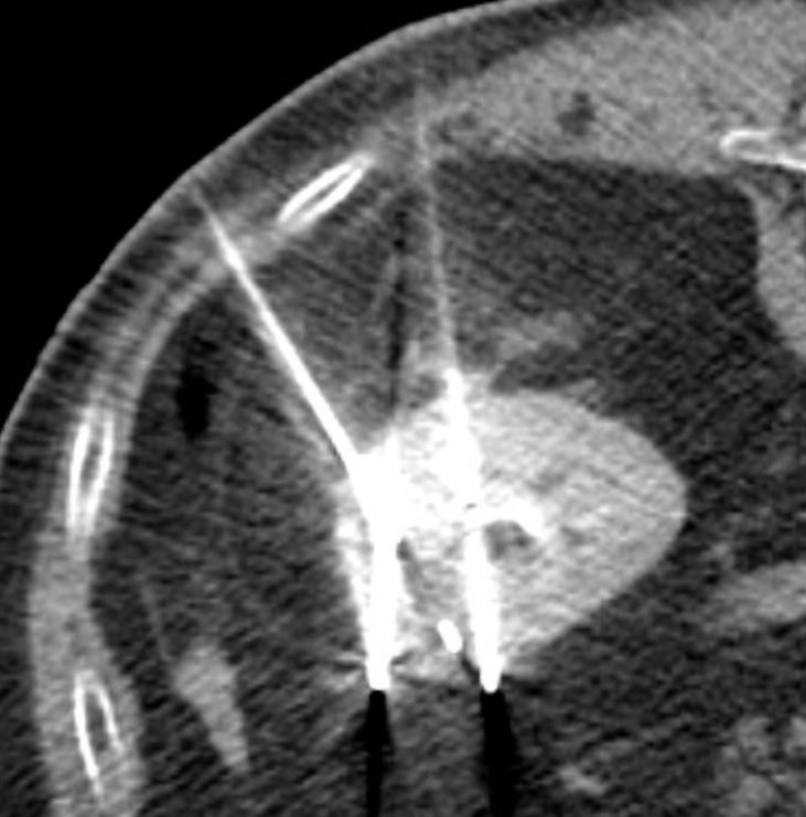 pparmetIR's tweet photo. 75 yo w/ endophytic renal mass referred for ablation. Poorly seen on US and NCCT, but intra-procedural IV contrast provided precise lesion delineation for cryoablation and biopsy needle placements. Pathology confirms clear cell RCC. #IceIceBaby #bracketology @SIRRFS @SIR_ECS https://t.co/Y5oD9pQdFj