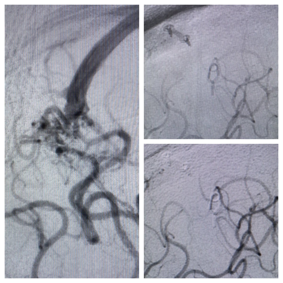 Justin Singer MD, FAANS on Twitter "Love how well this ICG