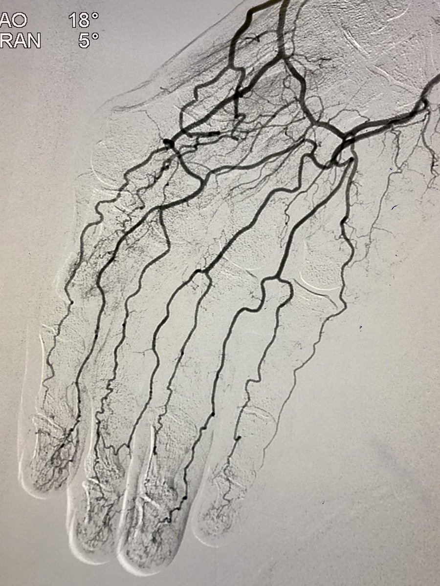 Sep. is #PADawareness month. PAD  can affect any vascular bed including arms. Pt had severe numbness, pain with weakness of right arm and very low blood pressures. Rxed with IVUS guided angioplasty transradial. Post pressure ⬆️by 60mmHg with immediate difference in sxs.