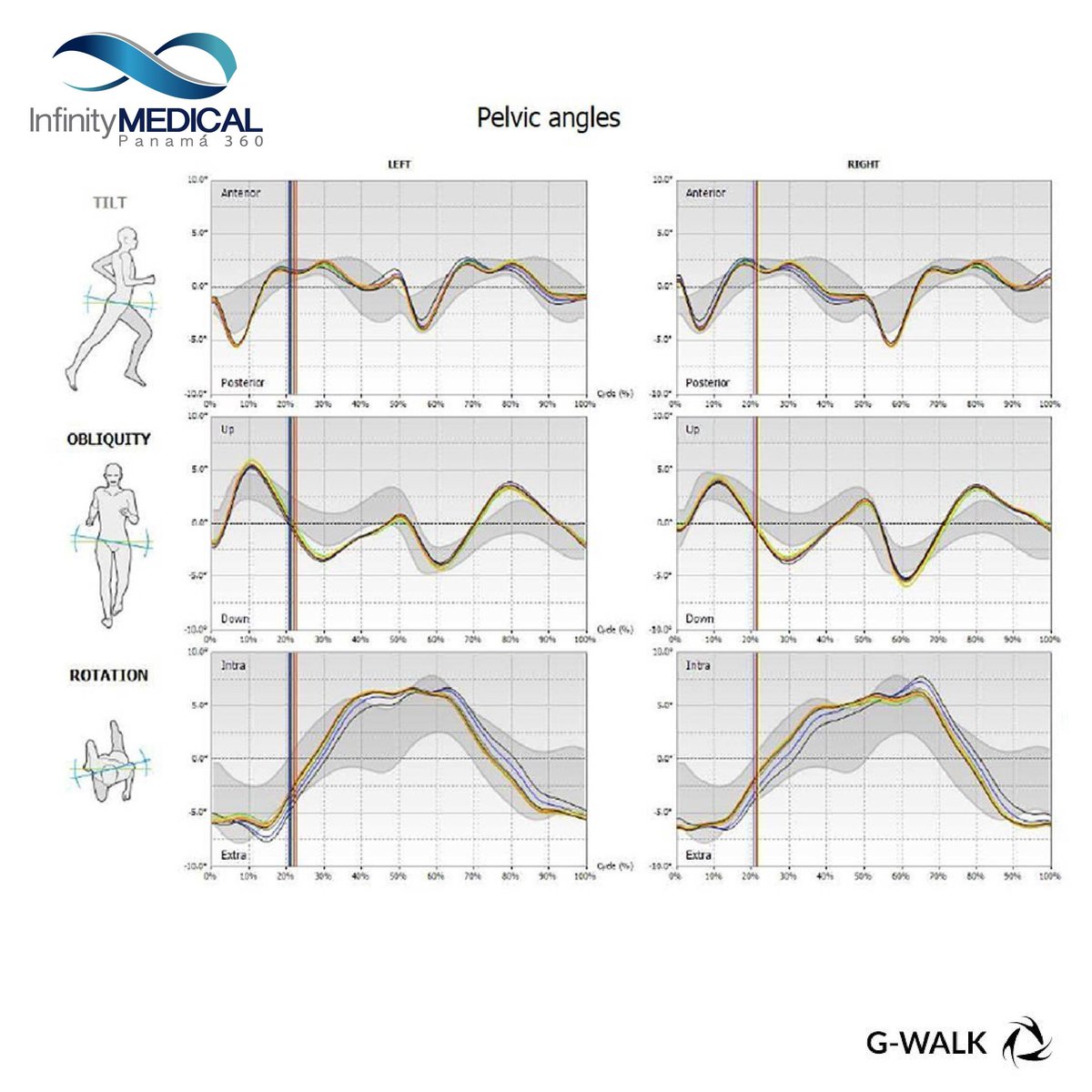 InfinityMedPma's tweet image. ☝️Este equipo también te permite realizar las #Puebas #Clínicas como el "𝙏𝙞𝙢𝙚 𝙐𝙥 𝙖𝙣𝙙 𝙂𝙤" y "𝙇𝙖 𝙋𝙧𝙪𝙚𝙗𝙖 𝙙𝙚 𝘾𝙖𝙢𝙞𝙣𝙖𝙩𝙖 𝙙𝙚 6 𝙈𝙞𝙣𝙪𝙩𝙤𝙨" en poco tiempo. 
Conoce más de este equipo:
6464-6947
 info@infinitymedicalpanama.com
#Panamá #movimiento