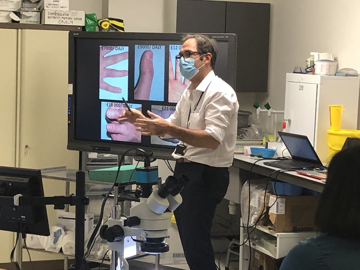 DrJamesKKChan's tweet image. Setting up and teaching on Stoke Mandeville #Microsurgery Course with @rebecca5hirley was 1 of the most fulfilling milestones in my career so far! Thanks @BHTMedEd @simtechjoe 4 @Severn_HC @ChrisKasbia1 4 making it happen!
@BAPRASvoice @AlistairJMReed @IRadotra @BucksHealthcare