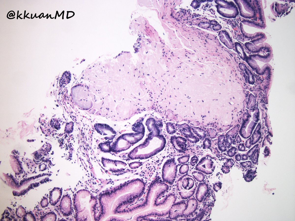 kkuanMD's tweet photo. 70yo male with weakness and weight loss. #GIpath #hemepath #gastro https://t.co/Pj2NegGINE