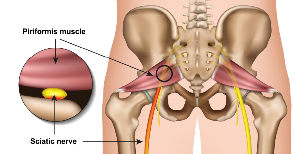 WebMD's tweet image. Too much sitting and too little exercise, among other things, can irritate and inflame your sciatic nerve -- causing hip and leg pain. More information: wb.md/2RAWwVV