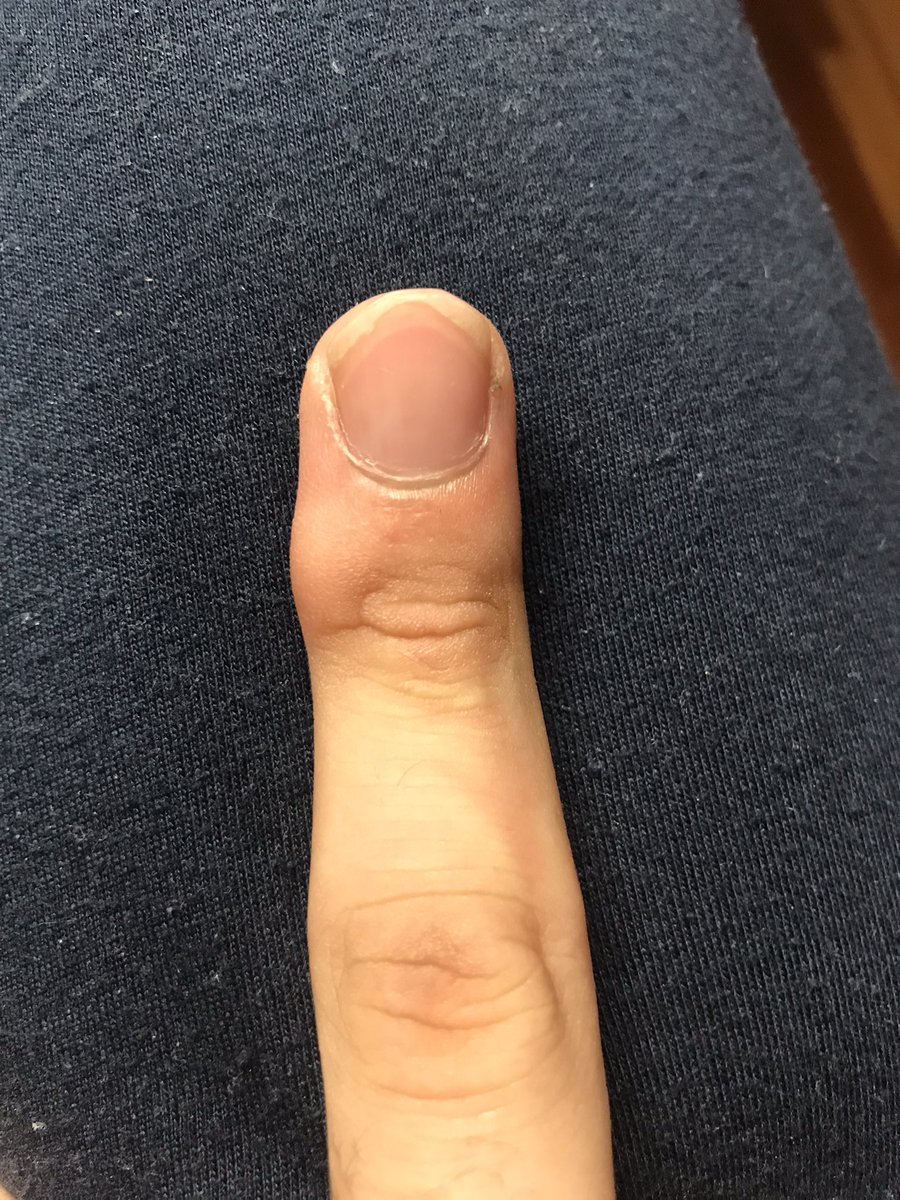 鉛筆だこ - Twitter Search / Twitter