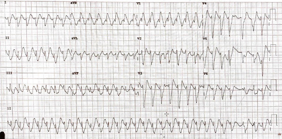 Peter Kas On Twitter Amphetamine Overdose Complexes Look Wide K Is 6 7mmol L What Do You Think Of The Ecg A Vt B Hyper K C Hyper K And Na Channel Block D