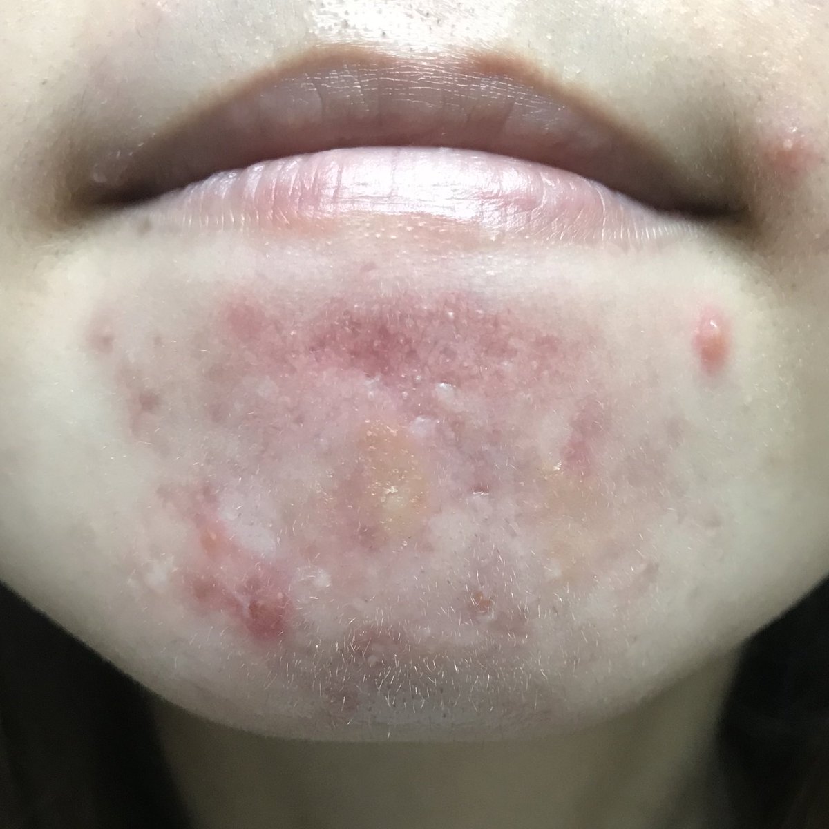 ニキビ撲滅夫婦 妻の顎ニキビを治そうの会 Nikibifu Fu Twitter