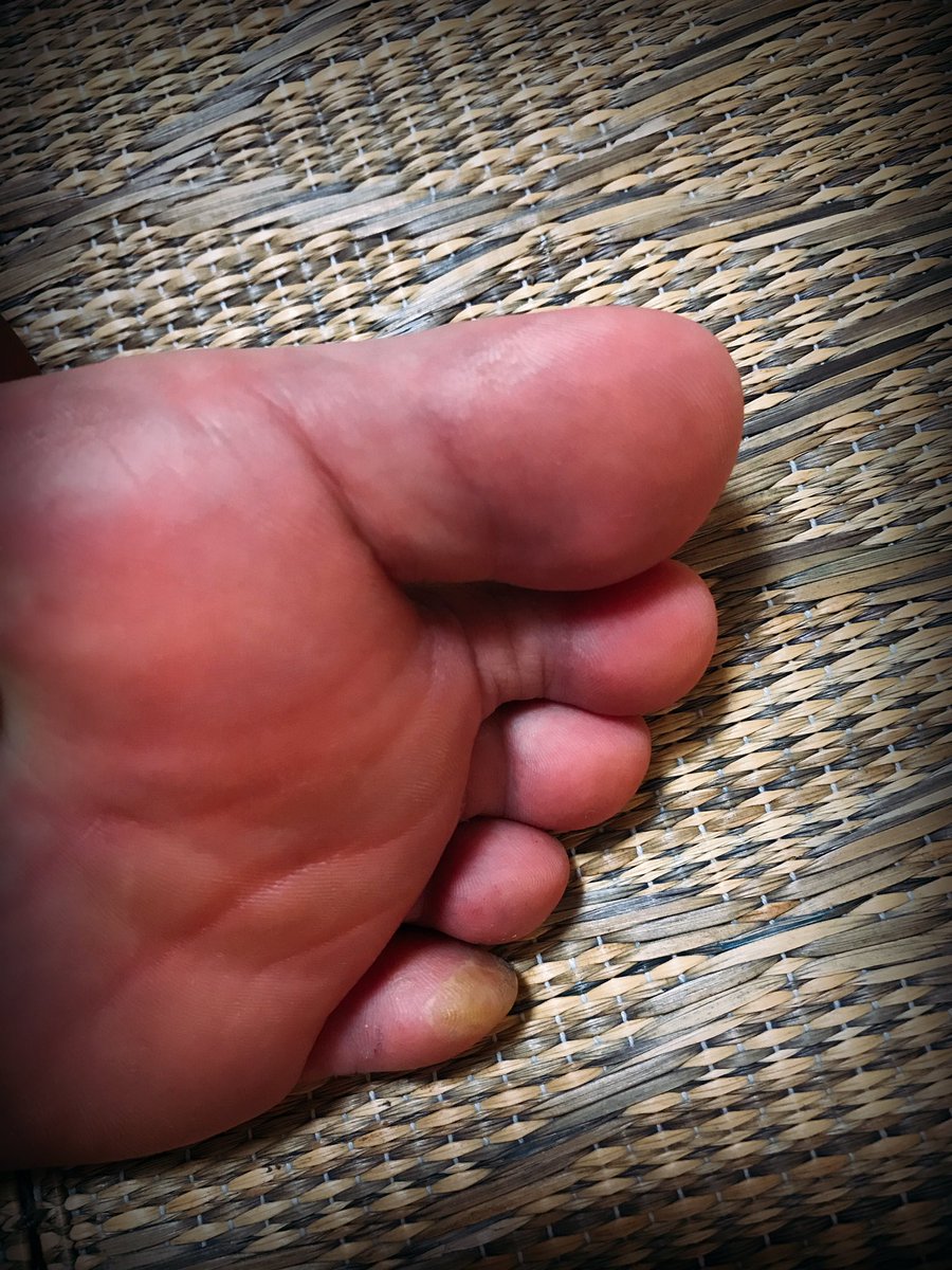 さっこ 5 7子宮筋腫開腹手術済 足の小指に水ぶくれできたの初めてー 歩きすぎ 水ぶくれ 靴擦れ さっこ 5 7子宮筋腫開腹手術済 足の小指に水ぶくれできたの初めてー 歩きすぎ 水ぶくれ 靴擦れ
