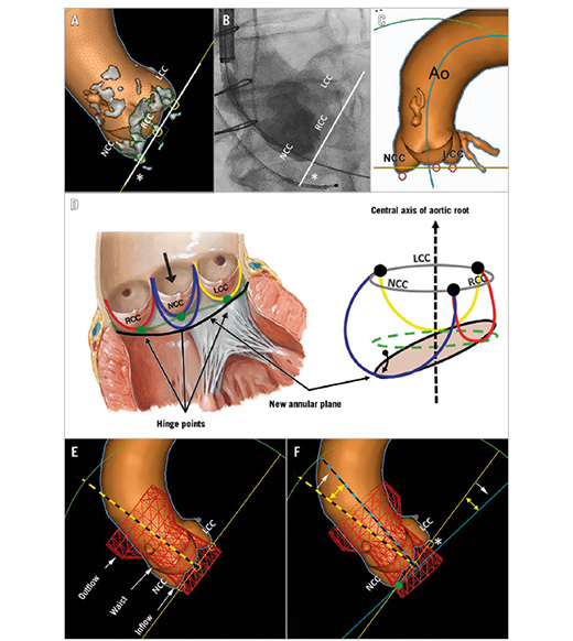Davide Capodanno (@dfcapodanno) on Twitter photo The 09/20 issue of <a href="/EuroInterventio/">EuroIntervention</a> is out, with valve-in-valve TAVI, sizing with abnormal aortic cusps, 1-year outcomes of complex PCIs from a registry of 36000, and a mini focus on physiology indexes (FFR, OFR, QFR, vFFR and any "xFR" comes to your mind)
eurointervention.pcronline.com/issue/volume-1… The 09/20 issue of <a href="/EuroInterventio/">EuroIntervention</a> is out, with valve-in-valve TAVI, sizing with abnormal aortic cusps, 1-year outcomes of complex PCIs from a registry of 36000, and a mini focus on physiology indexes (FFR, OFR, QFR, vFFR and any "xFR" comes to your mind)
eurointervention.pcronline.com/issue/volume-1…