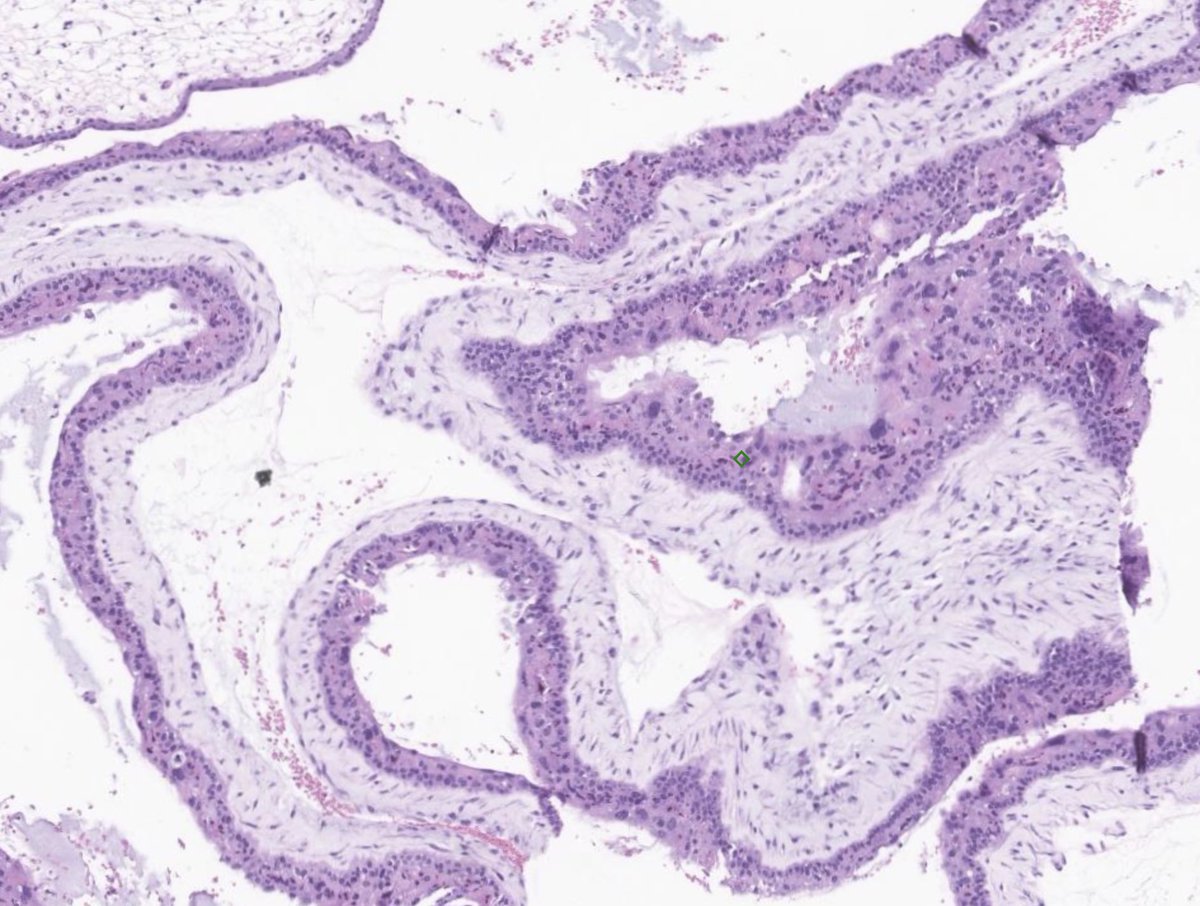 Mooshable's tweet image. Does this count as fetal tissue?
Dual population of villi, cisterns, focal non-polar syncytiotrophoblast proliferation, umbilical cord, and actual fetal tissue seen in partial hydatiform mole #PlacentaPath