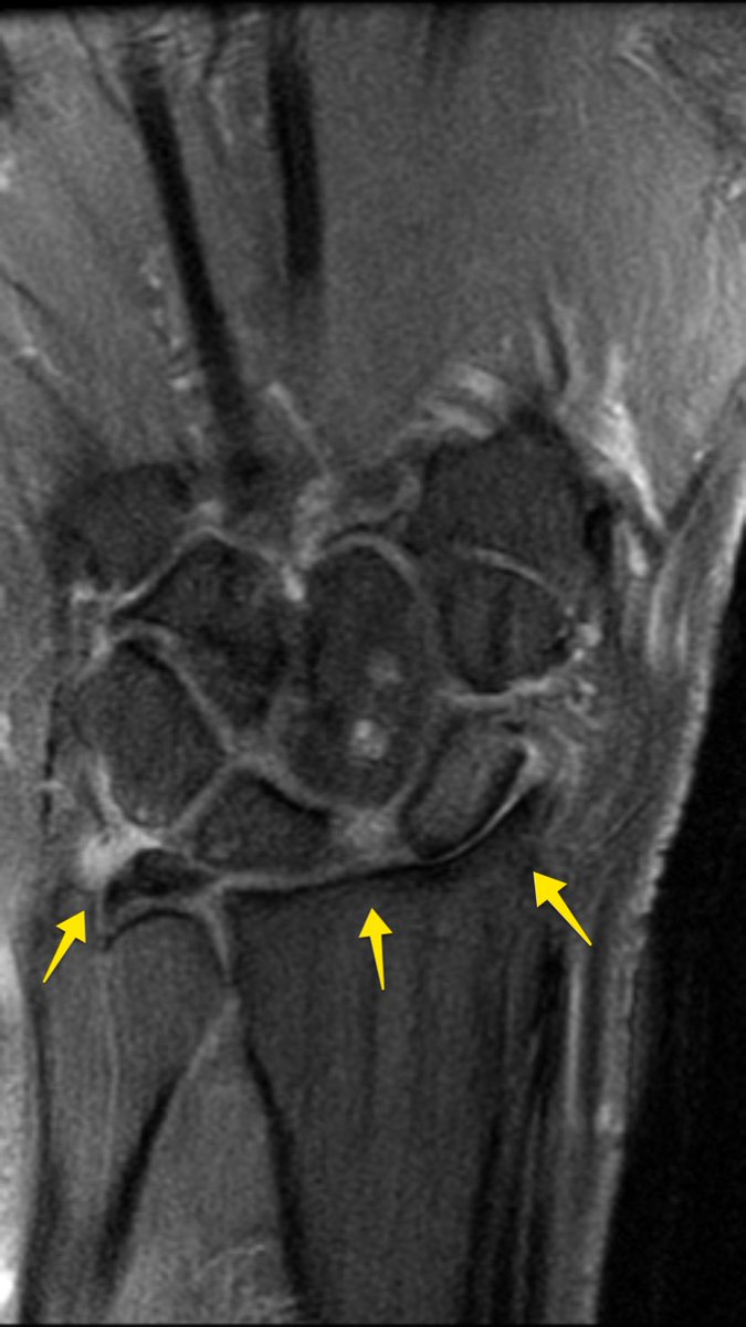 Baez1Adan's tweet photo. #radres #FOAMrad SLAC type 2 lesion due to old trauma, high grade SL ligament partial tear + radioscaphoid Osteoarthitis + minimal proximal capitate migration + DISI. Also seen complex Non Palmer TFC lesion. @SermeMsk @MskSerme https://t.co/BA5XSuOSeR