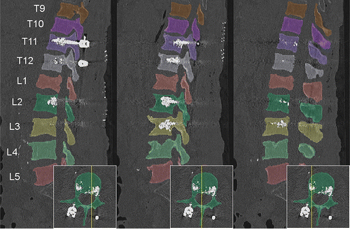 AI_Spine's tweet photo. Today we highlight the work of Löffler et al. A Vertebral Segmentation Dataset with Fracture Grading published in @Radiology_AI. They used deep learning CNN for vertebral segmentation and a semi-quantitative method to classify vertebral fracture https://t.co/xb4maGWIrR
#Thread https://t.co/ykKdVCmaGN