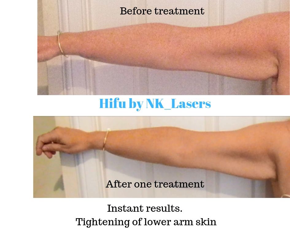 LasersNk's tweet photo. Exciting news!! NK_Lasers Hifu is coming to #Edinbugh and #Bridgeof Allan
#Hifu is your non-surgical #facelift
browlift
necklift
#bumlift
for arms, tummy, thighs & hands.
One treatment-No injections-No downtime
Appointments are limited. Pm to book your appt.
£99 per area.. https://t.co/Az5cvyTMHe