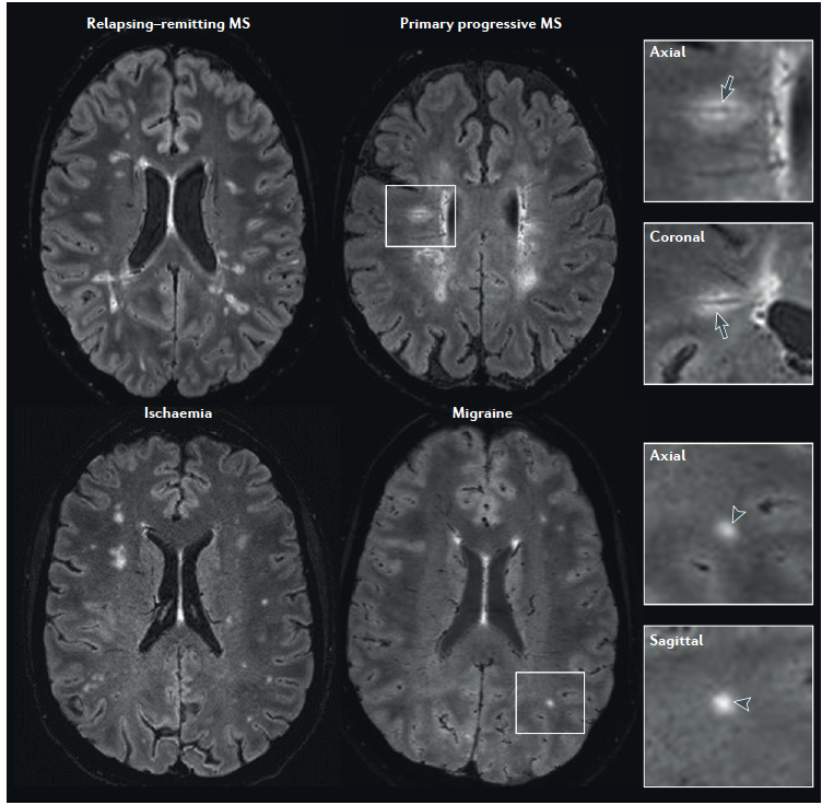 3. Central Vein Sign resembling "coffee bean" or "doughnut" may be useful for distinguishing  #MultipleSclerosis lesions from other white matter lesions, e.g.,  #migraine Sati, P. et al. Nat Rev Neurol 12, 714–722 (2016)