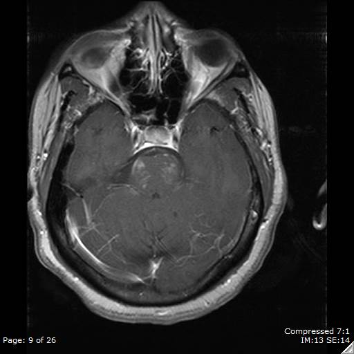 4. Young man presents with ataxia, nystagmus, MRI below, LP x 2 negative for OCB. Be mindful of CLIPPERS. Steroid responsive, lymphocytes present but no demyelination. Case courtesy of Dr Vahe Michael Zohrabian,  http://Radiopaedia.org , rID: 42630