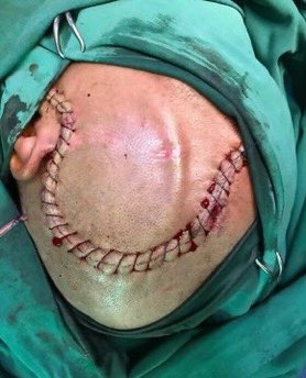 This patient now has a skull made of metal