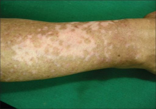 Imagen: El brazo de una persona muestra manchas de piel descolorida por el vitíligo.