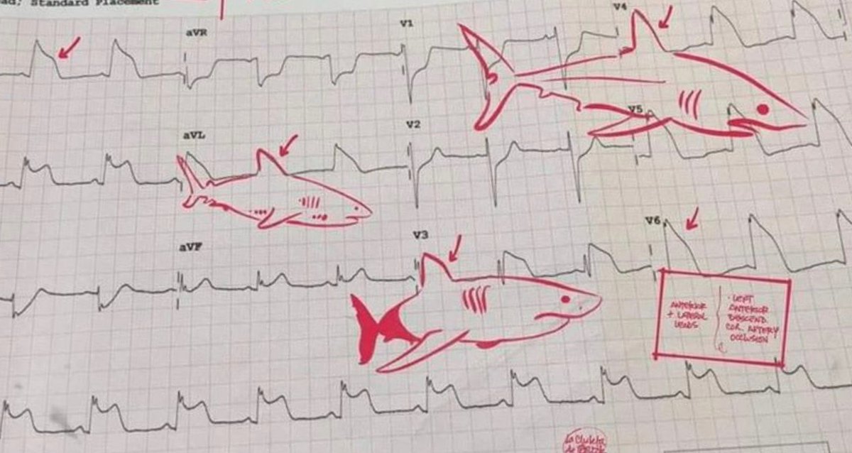 The Shark Fin Sign: concern for acute coronary occlusion as the QRS and T wave merge secondary to extreme ST elevation. It may get confused for hyperkalemia. #ACS #ECG #EPeeps #cardiotwitter #radialfirst