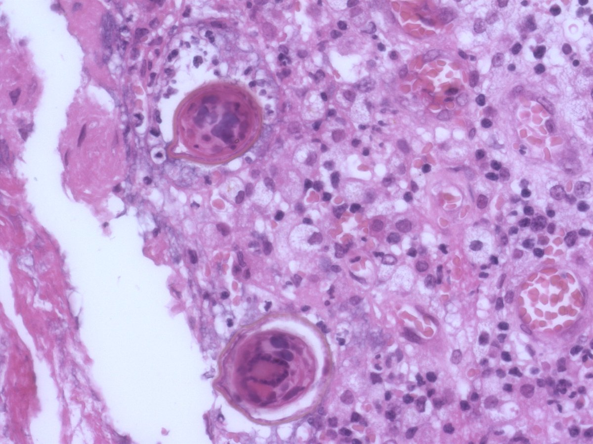 RunjanChetty's tweet photo. @DrAhmedKalebi @padmapathology1 @ariella8 @f_unal @DrGeeONE @vi_monappa @nusrat_xahra @TristanRutland7 @Teclis82 @Kashifhazim @Vik_deshpandeMD From the contents of the liver abscess. https://t.co/M1DoEUC1k9