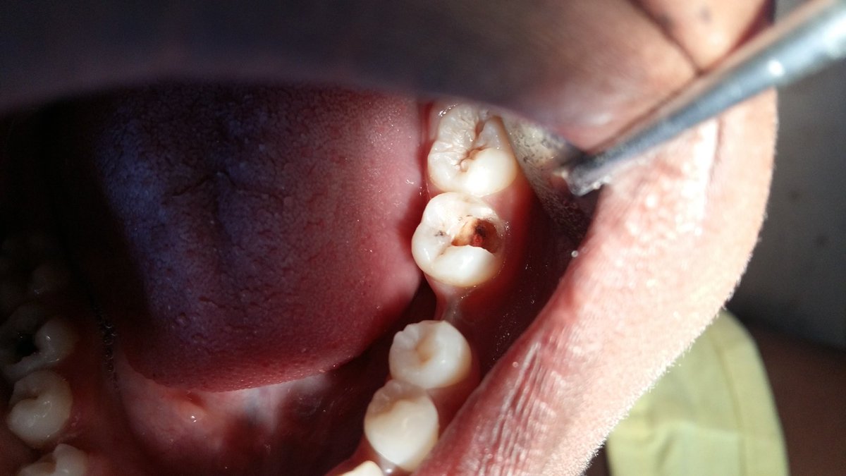 Deogratias17's tweet photo. A. Matibabu ya mzizi wa jino
(Root Canal Treatment)
Jino likitoboka na kufika kwenye kiini (pulp), linakuwa na dalili zifuatazo
1. maumivu makali yanayoanza yenyewe muda wowote 
2. Maumivu ukila au kunywa vitu baridi na moto na vyakula vyenye sukari @JamiiHealth
@furia_francis https://t.co/xq78RAm6m0