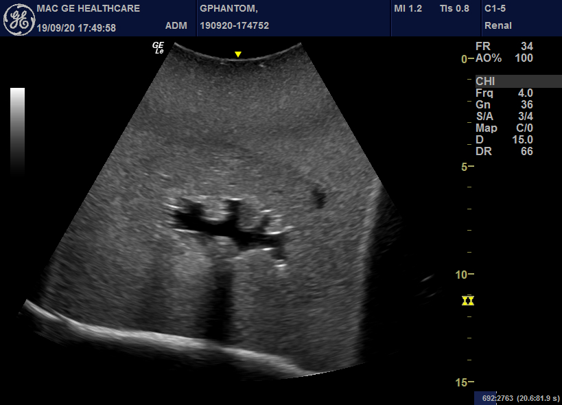Approximately 30 professionals used Gphantom Kidney during the last hands-on at <a href="/EndouroB/">Endouro Brigadeiro</a> , if we consider 5 tries for each user we had at least 150 punctures on Gphantom Kidney. Where are the needle tracks? <a href="/VicentiniUro/">Fabio Vicentini 🇧🇷</a> did you approved?