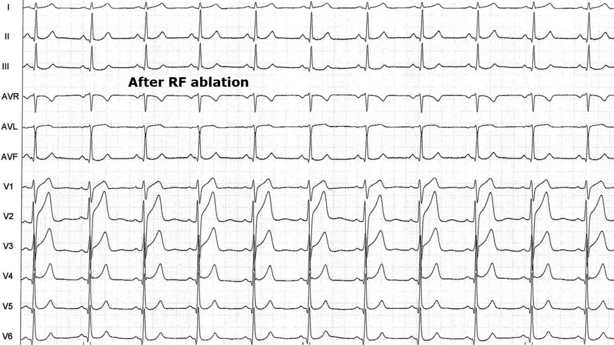 messapus's tweet photo. 23M, previous #sport activity, absence of structural heart disease, high-burden and symptomatic monomorphic #PVC and NSVT: juicy potentials in RVOT and #arrhythmia gone with @RFablation No need for fluoroscopy #NoFluoro #NoXRay #ablateVT #ECG #EPeeps @sozi81 https://t.co/vyWrLzZstH