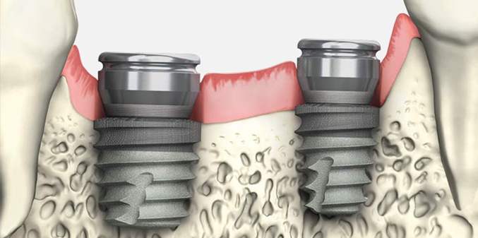 ImplantPractice's tweet photo. When vertical bone height is limited, Tapered Short dental implants can expedite treatment by avoiding bone grafting procedures. 

Learn more with @BioHorizons: https://t.co/5jq19sEYBE

#DentalImplants #HealthySmiles #FasterFewer #dentistry #implantology #biohorizons #dds #dental https://t.co/IRyaeNnkZ0