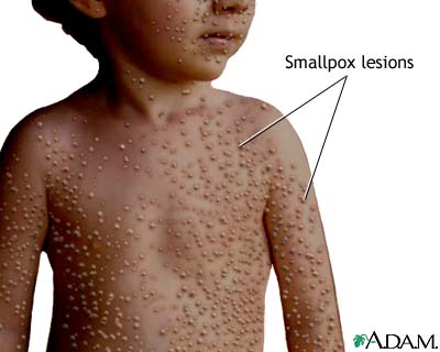 A young dairymaid had fresh cowpox. Jenner transferred some material from her skin lesions to an 8-year old boy’s skin. The boy had some mild fever but was otherwise quite well.2 months later, Jenner repeated with smallpox but the boy had no fever.This pic is smallpox. (3/6)