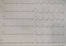 Hombre 51 años, sin historia cardiovascular previa. F1: Signo de Frank (SF). F2: IAMCEST anteroseptal.  ¿Cómo es que detalles tan pequeños pueden decir tanto? ¿Cómo están relacionadas estas dos imágenes? <a href="/andreagallardo/">Andrea Gallardo</a> <a href="/drdargaray/">Diego Araiza MD</a> <a href="/dr_ezquerra/">Dr. Alex Ezquerra</a> @CriticalCV
