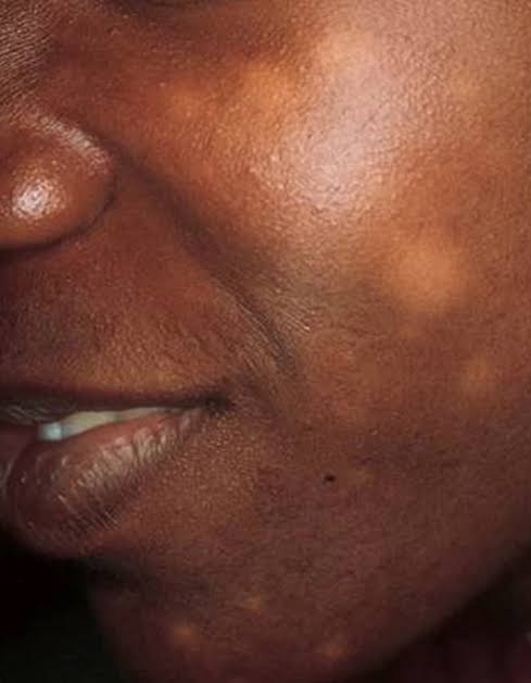 CorrectRadioTV's tweet photo. We don enta inside #TalkDMata as dis week be "National Eczema Week" we get @flakydancindoc (Dermatologist) to helep torchlight di Eczema/Pityriasis Versicolor mata.
Dis nah #UNAHGUDMORNINGLagos with @correctpesin & @betyanaa
#CorrectFmLagos https://t.co/SxCCfK7smA