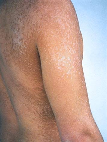 CorrectRadioTV's tweet photo. We don enta inside #TalkDMata as dis week be "National Eczema Week" we get @flakydancindoc (Dermatologist) to helep torchlight di Eczema/Pityriasis Versicolor mata.
Dis nah #UNAHGUDMORNINGLagos with @correctpesin & @betyanaa
#CorrectFmLagos https://t.co/SxCCfK7smA