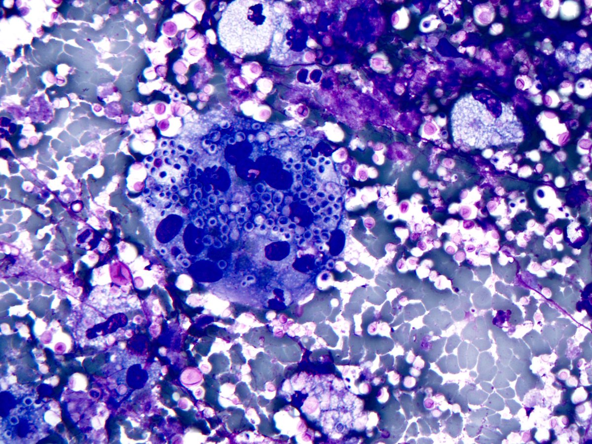 smlungpathguy's tweet image. Are you team Diff-Quik or team Pap? 

#cryptococcus #cytopath #pathology #pulmpath #croutoncell #fungus