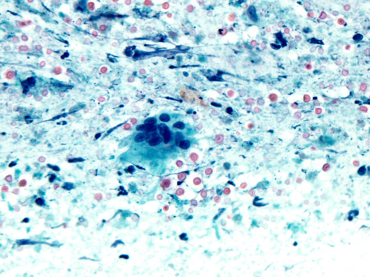 smlungpathguy's tweet image. Are you team Diff-Quik or team Pap? 

#cryptococcus #cytopath #pathology #pulmpath #croutoncell #fungus