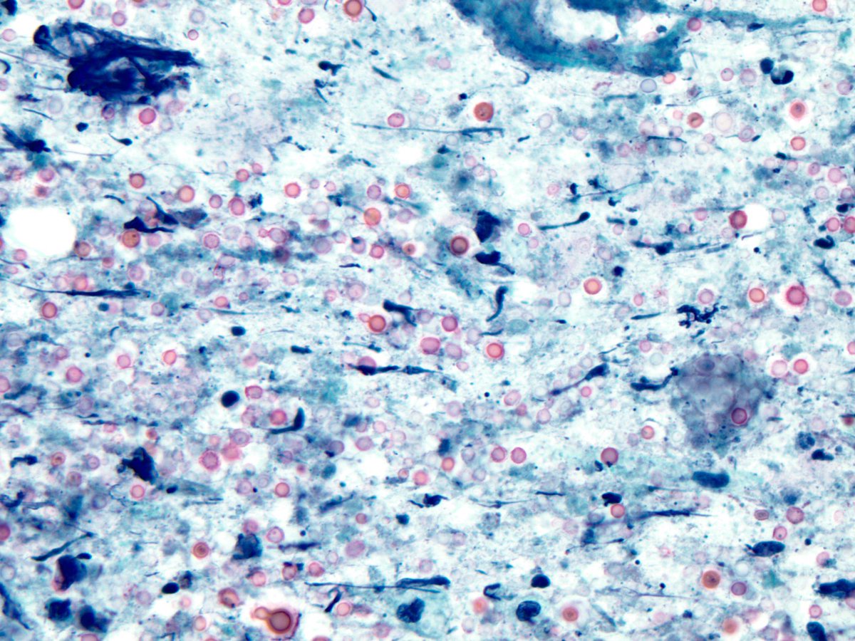 smlungpathguy's tweet image. Are you team Diff-Quik or team Pap? 

#cryptococcus #cytopath #pathology #pulmpath #croutoncell #fungus
