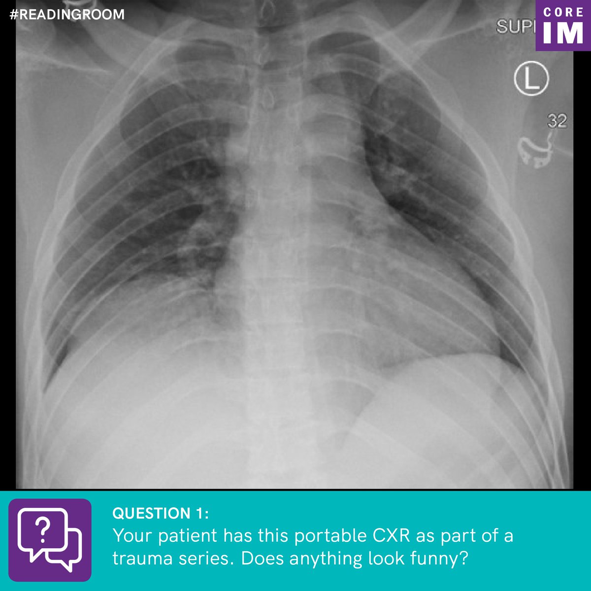 1/  #ReadingRoom: Your patient has this portable CXR as part of a trauma series. Does something look funny!? By  @StefanTigges | Graphic:  @SalimNNajjar