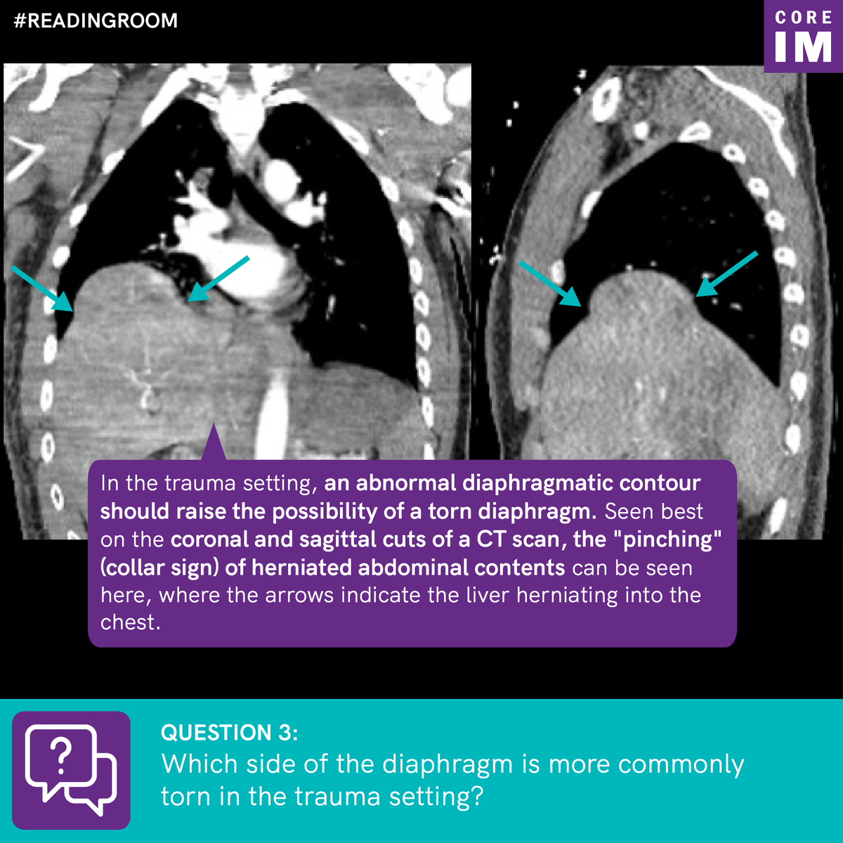 3/ How would you better evaluate that diaphragm?! Get those coronal and sagittal CT views!