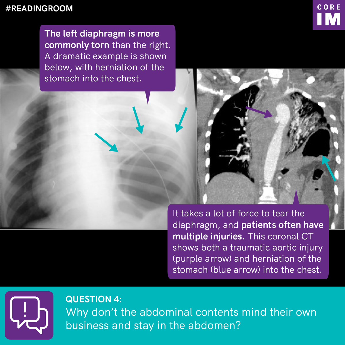 4/ Which side do we more commonly see a  #torn diaphragm and more likely to see the “ #pinching” (collar sign)?