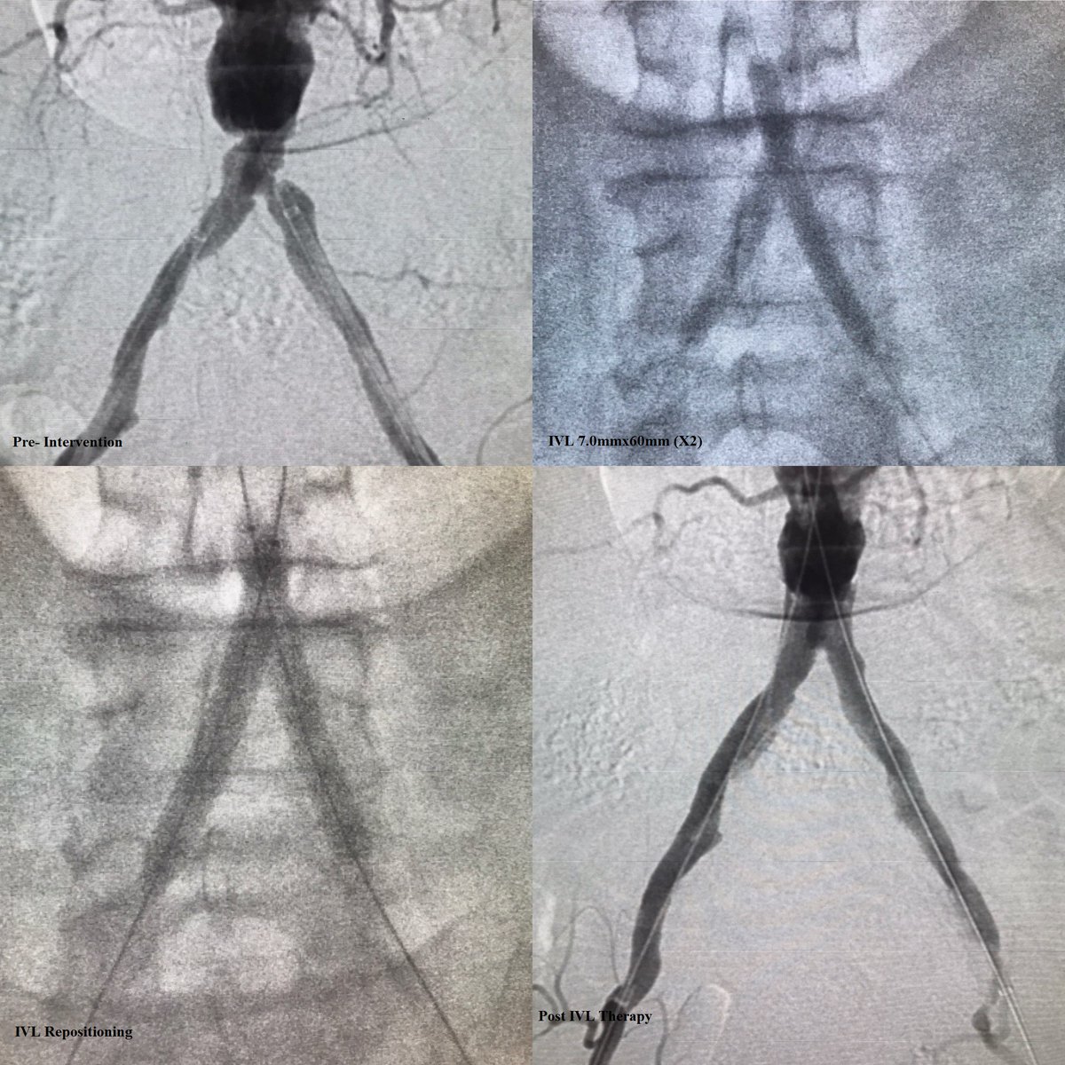 ShockwaveIVL's tweet photo. Dr. Nathan Aranson @naransonmd walks us through his outstanding “kissing” bilateral #ShockwaveIVL case, detailing how he used #IVL to treat aortoiliac occlusive disease (#AIOD), on #TheCatalystBlog: https://t.co/p9H8TmKeEk
ISI https://t.co/Q2peu4kDd6 #CardioTwitter @MaineMedVasc https://t.co/ACG2JhVR3w