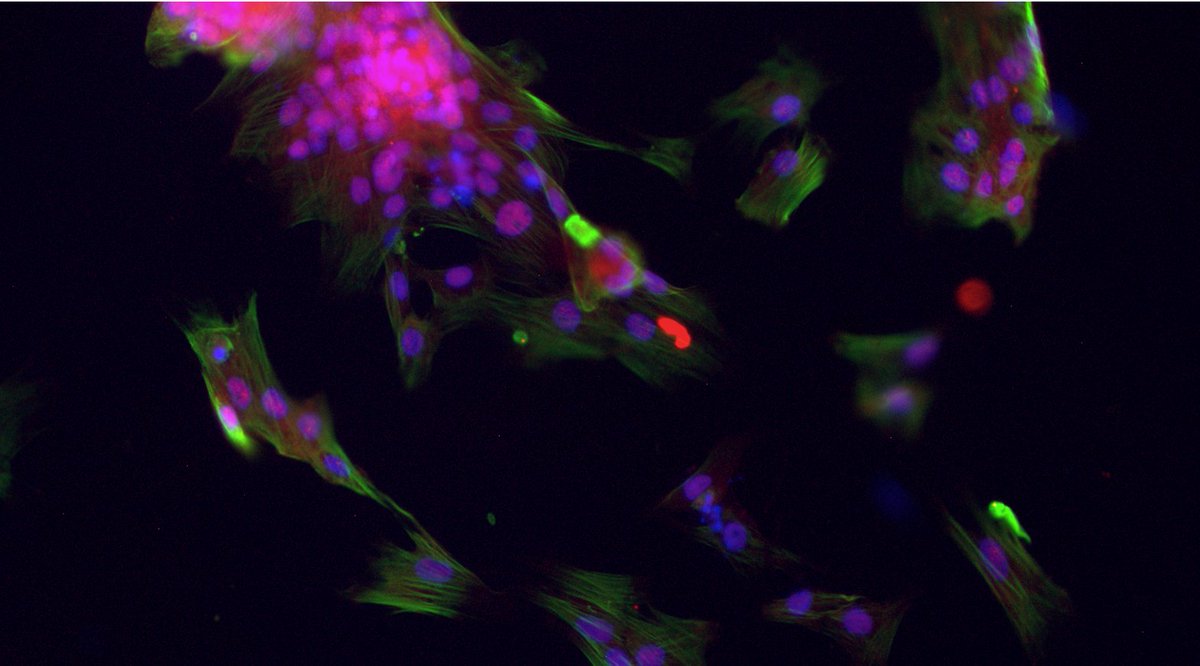 Over time, VICs/myofibroblasts can become osteoblast-like cells (red), which cause calcification of valve tissue, making the tissue bone-like. Little is known about the biological processes that control the switch from myofibroblasts to osteoblast-like cells. 6/n