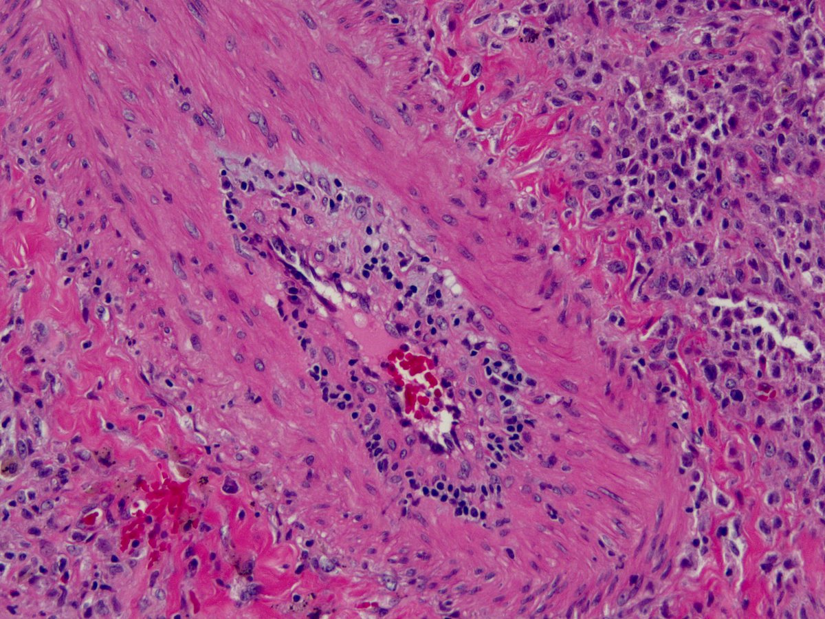 O Brave and Wise, teach me how to correlate these lung biopsy findings with clinical findings. Germinal center (pattern?) + vasculitis (uh...pattern?) + NSIP (pattern!) = ? Clinical correlation recommended? Some say say germinal centers are diagnostic of CTD. What say you?