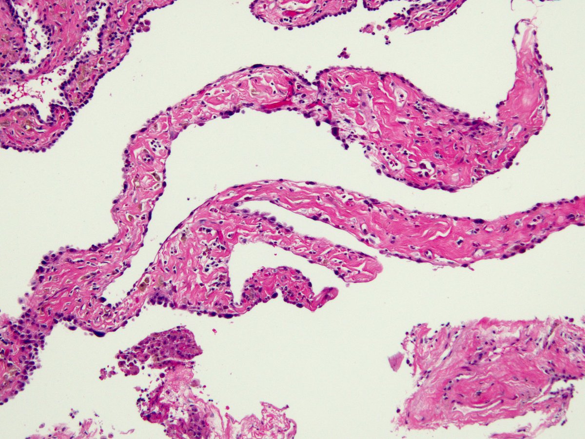 O Brave and Wise, teach me how to correlate these lung biopsy findings with clinical findings. Germinal center (pattern?) + vasculitis (uh...pattern?) + NSIP (pattern!) = ? Clinical correlation recommended? Some say say germinal centers are diagnostic of CTD. What say you?