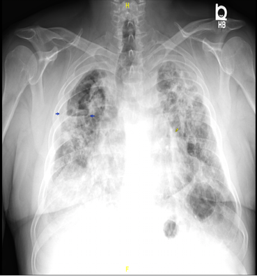 Case!55 YO resp failure, persistent cough, fatigue was being worked up for ILD as an outpatient. Admitted to the hospital with abnormal Xray/CT findings. No weight loss, anorexia. H/O sandblasting for 20 years and painting septic tanks. AFB cx + in 8 d, genexpert -.