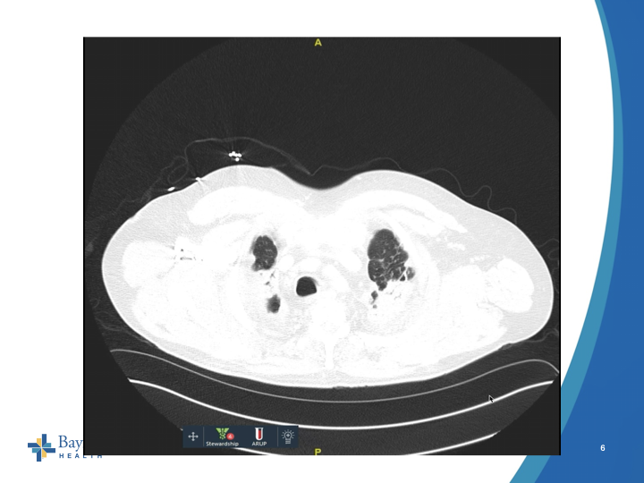 Case!55 YO resp failure, persistent cough, fatigue was being worked up for ILD as an outpatient. Admitted to the hospital with abnormal Xray/CT findings. No weight loss, anorexia. H/O sandblasting for 20 years and painting septic tanks. AFB cx + in 8 d, genexpert -.