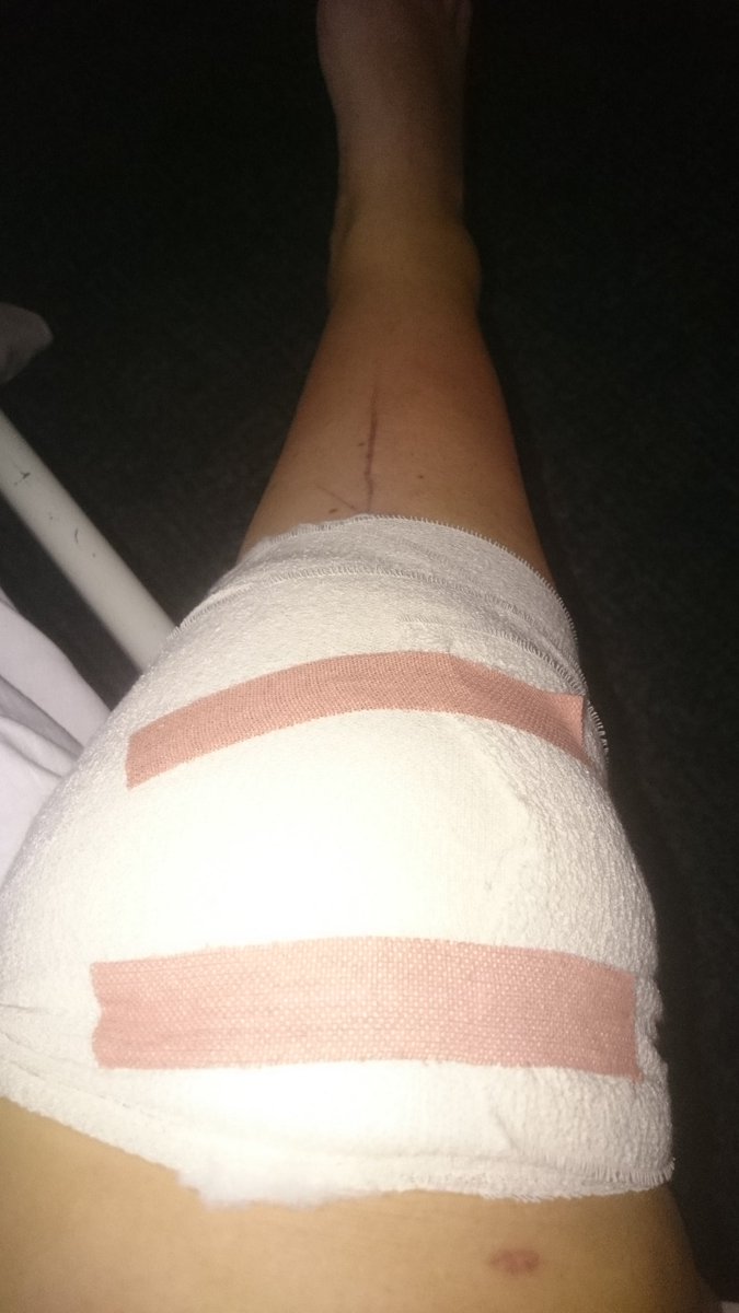 Waited 17 months for this first op following my #ski accident . Meniscus tear was pretty serious but it's now been trimmed and on the way to recovery 😁. Back on the crutches for a short while again but finally on my way to walking properly again.