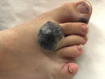 Check out "Blue rubber bleb nevus syndrome in a 10-year-old child treated with loop ligation facilitated by double-balloon enteroscopy" by Nikolaos Lazaridis et al in the September issue of VideoGIE. videogie.org/article/S2468-…